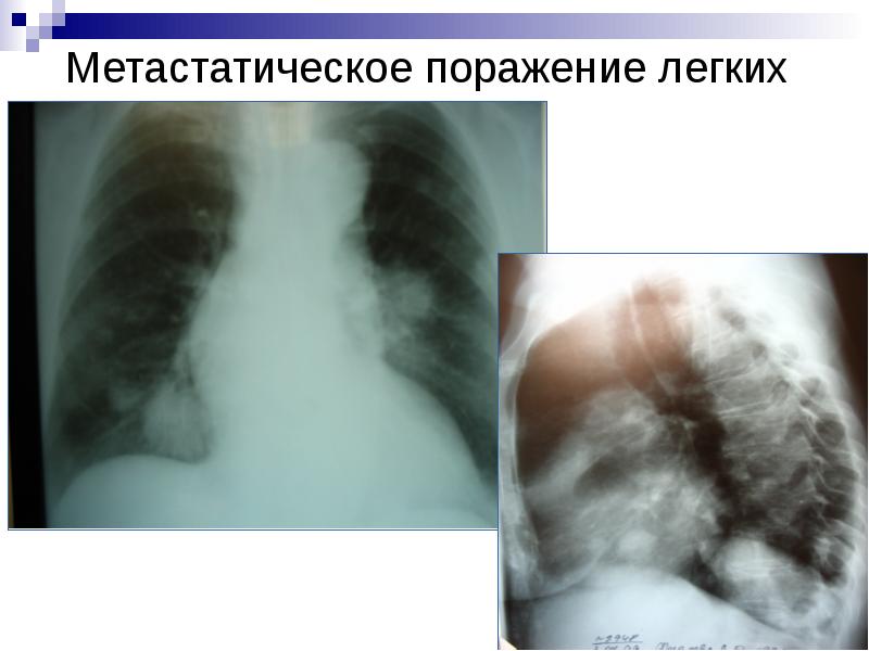 Поражение легких. Метастатическое поражение легких. Обширное поражение легких. Полное поражение легких.