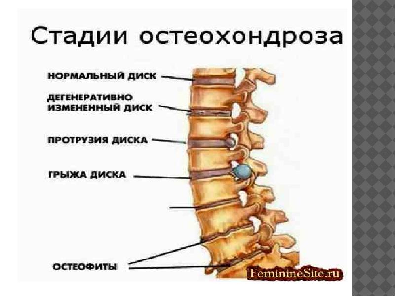 Профилактика остеохондроза презентация