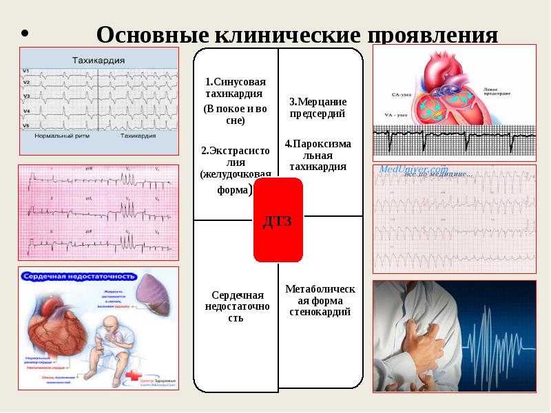 Экг при тиреотоксикозе картинки