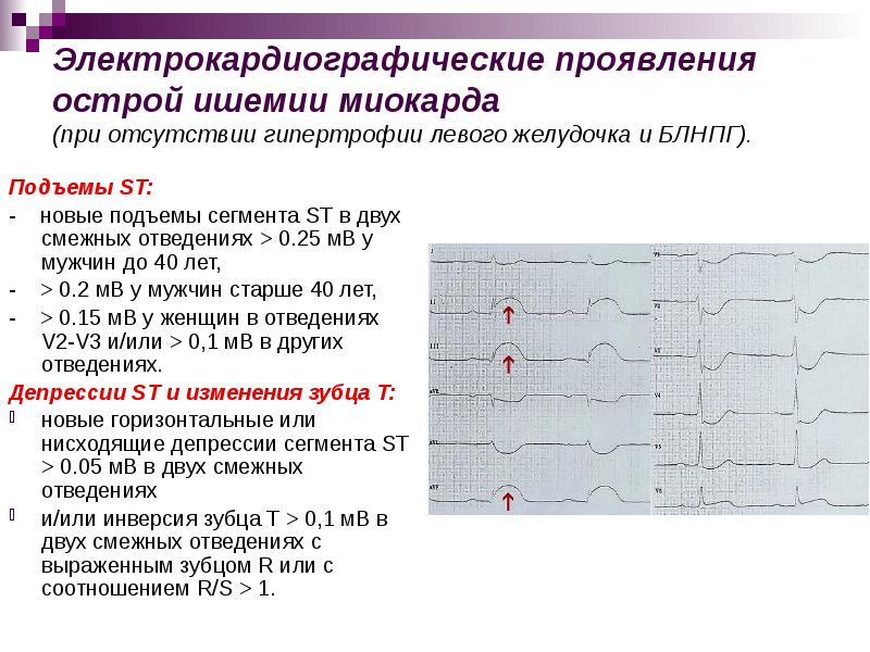 История болезни по инфаркту миокарда образец