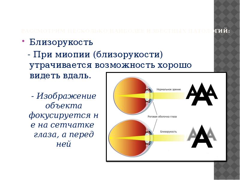 Слабая миопия