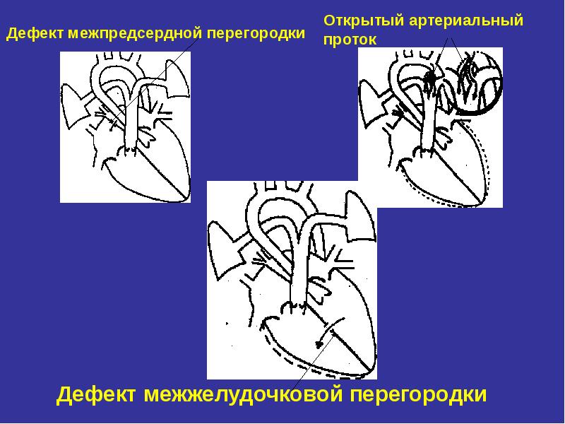 Открытый артериальный проток презентация