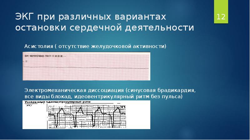 Асистолия на экг фото