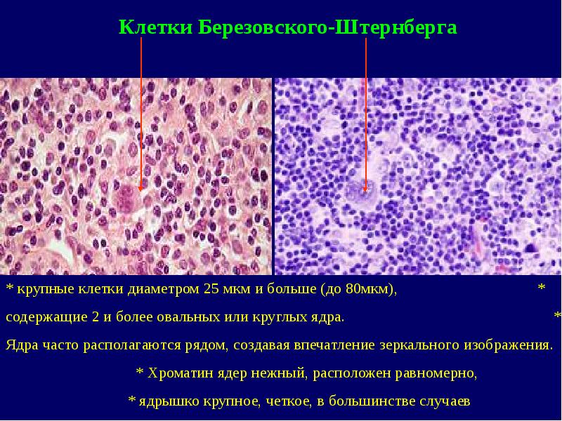 Лимфогранулематоз онкология презентация