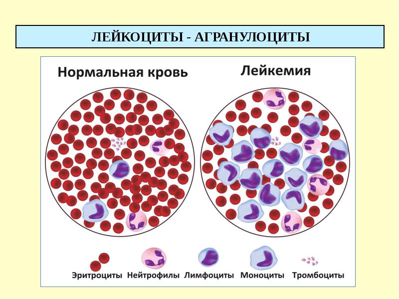 Картина крови при лейкозах