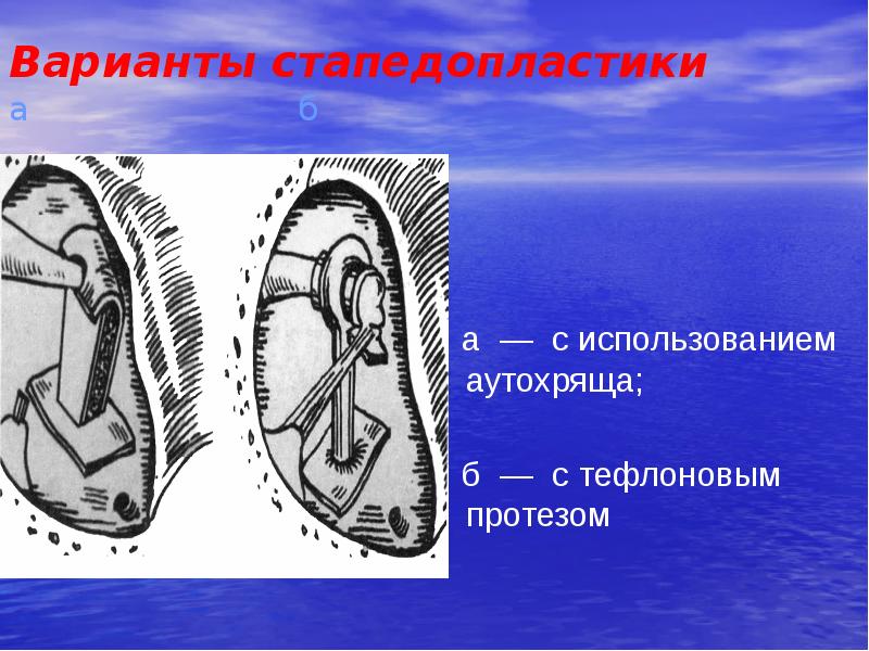 Стапедопластика