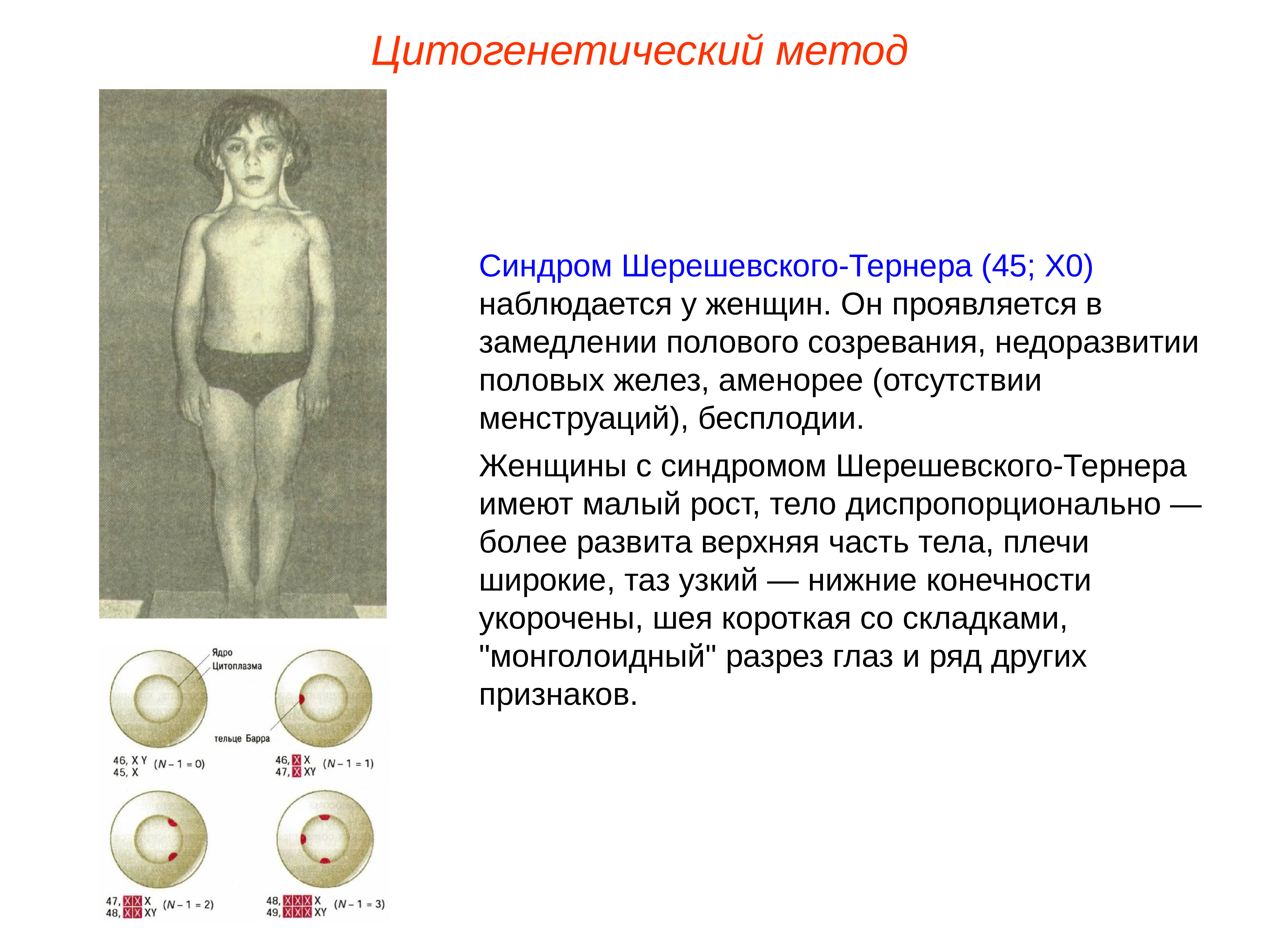 Синдром шерешевского тернера презентация по генетике