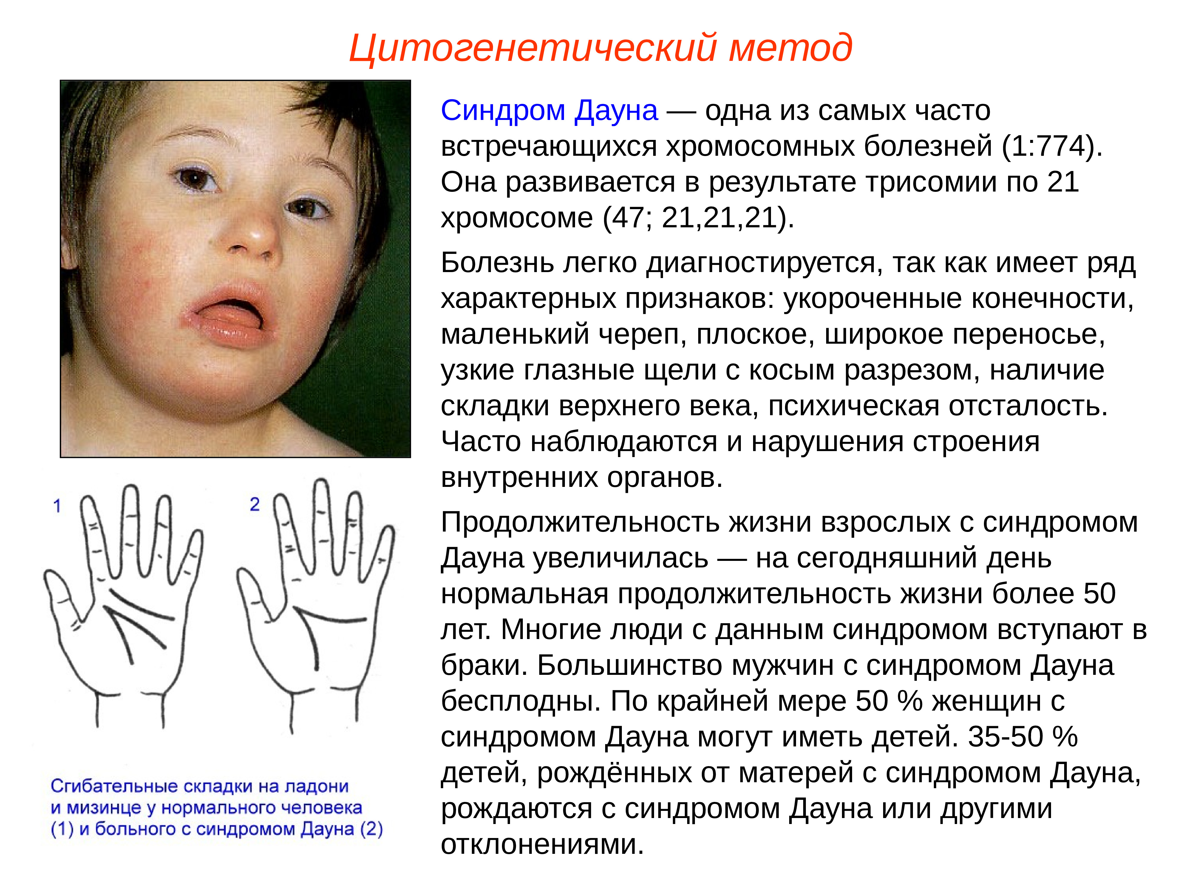 Фенотип ребенка с синдромом дауна. Синдром Дауна минимальные диагностические признаки. Характеристика больных синдромом Дауна. Синдром Дауна фенотипическая характеристика. Синдром Дауна фенотипическая характеристика причины возникновения.