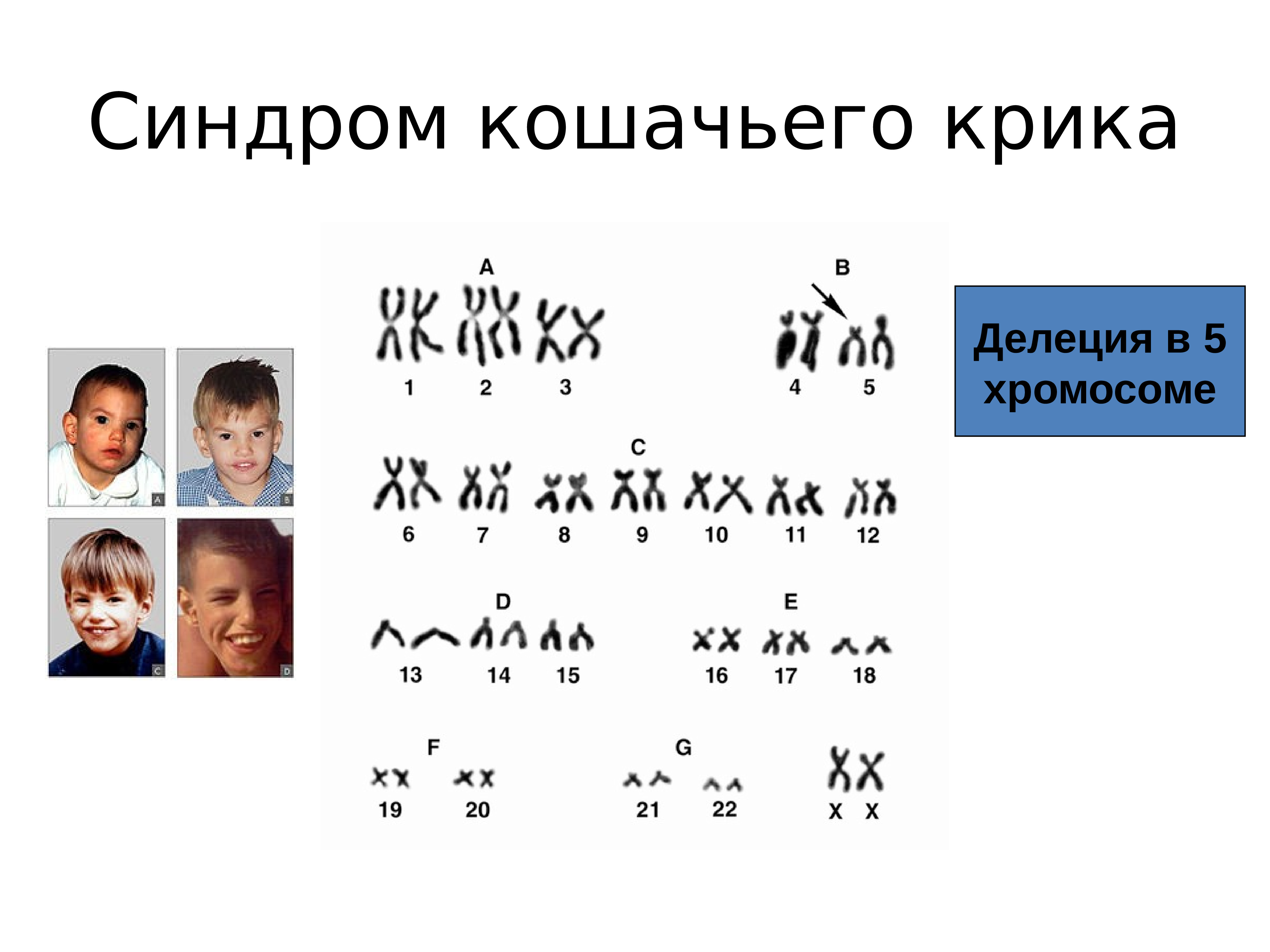 Каким номером на рисунке обозначен тип мутации характерный для больных с синдромом кошачьего крика