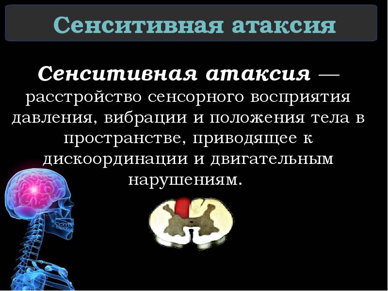 Сенситивная атаксия Сенситивная атаксия — расстройство сенсорного восприятия давления, вибрации и