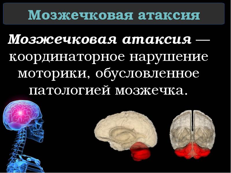 Мозжечковая атаксия