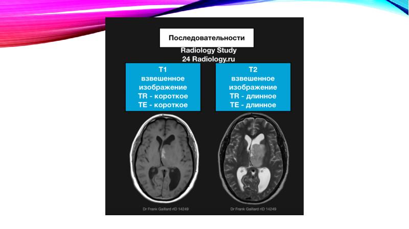 На т2 взвешенных изображениях при нативной магнитно резонансной томографии хорошо визуализируются