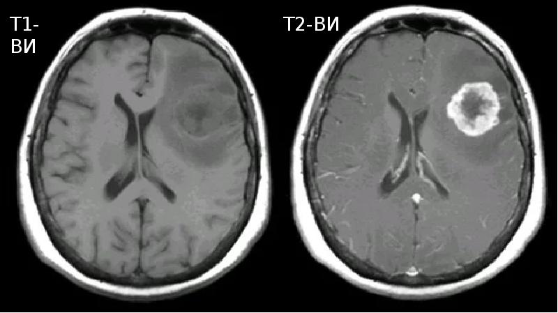 Т1 и т2 взвешенные изображения в мрт отличия