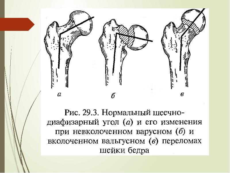 Перелом шейки бедра карта вызова