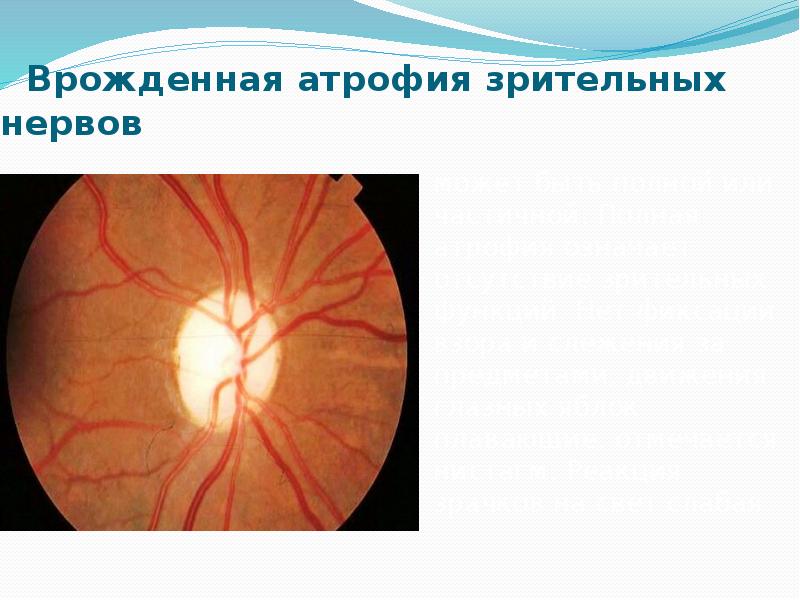 Образование зрительного нерва. Врожденные аномалии ДЗН. Врожденная атрофия зрительного нерва. Врожденная патология зрительного нерва.