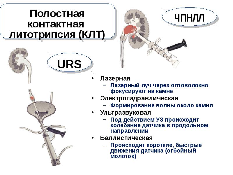 Удаление камней лазером. Контактная литотрипсия. Контактная лазерная литотрипсия. Контактная уретеролитотрипсия. Контактная литотрипсия (КЛТ).