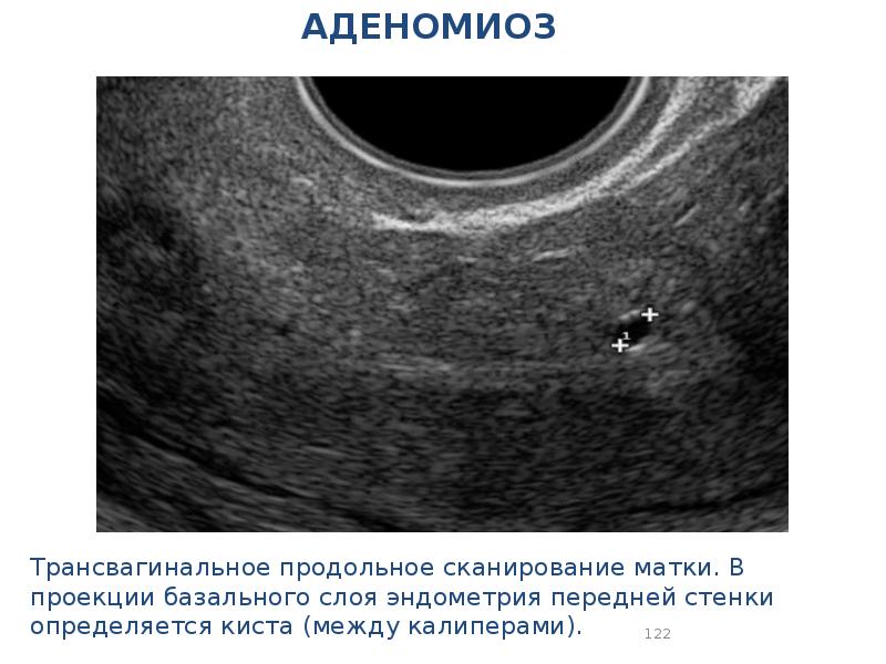 Как выглядит эндометрий в матке фото