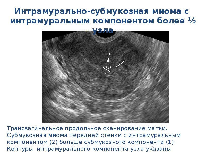 Матки можно забеременеть. Множественная миома матки УЗИ. Интрамуральный миоматозный узел на УЗИ. Внутристеночная миома. Интрамуральная субмукозная миома матки что это такое.