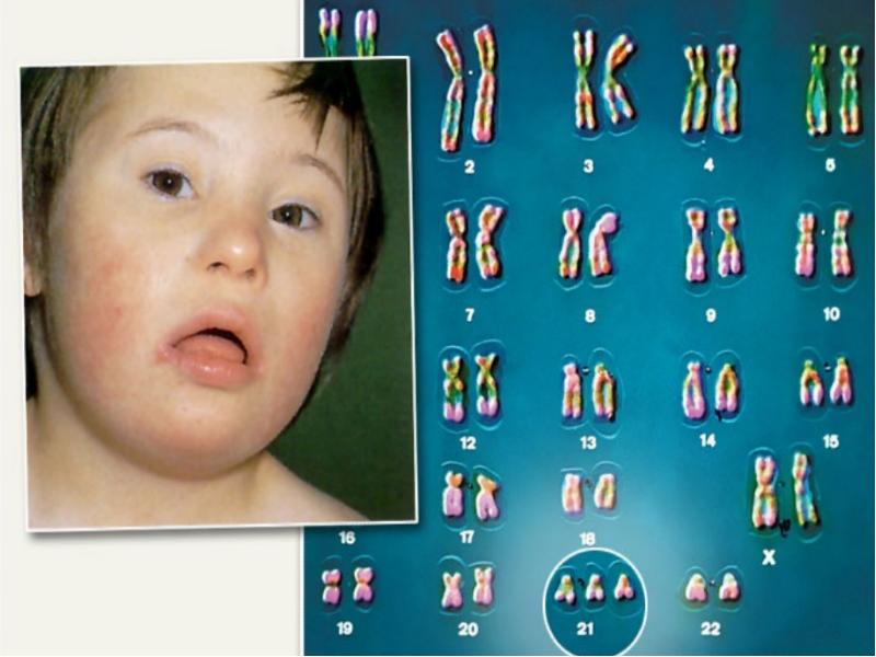 Хромосомные заболевания дауна. Хромосомные мутации. Синдром Дауна хромосомная мутация. Синдром Дауна геномная мутация. Болезнь Дауна хромосомы.