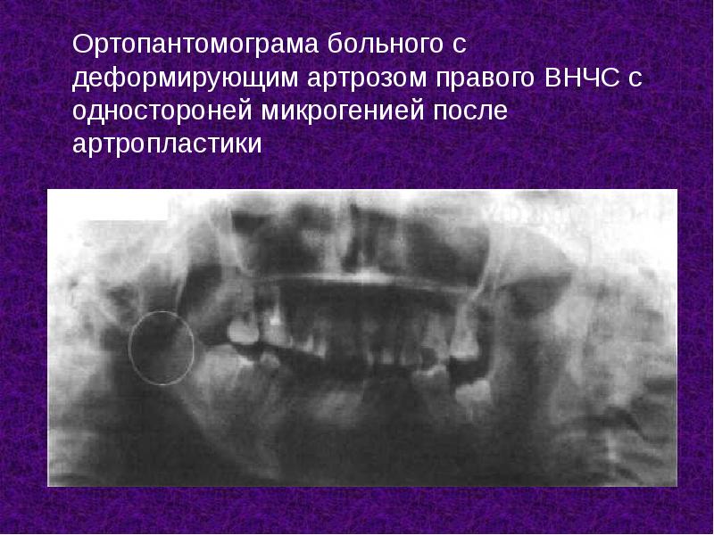 Ортопантомограма больного с деформирующим артрозом правого ВНЧС с одностороней микрогенией после Ортопантомограма больного с деформирующим артрозом правого ВНЧС с одностороней микрогенией после
