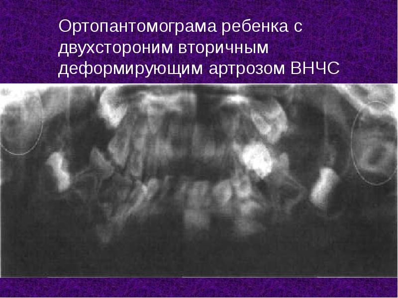 Ортопантомограма ребенка с двухстороним вторичным деформирующим артрозом ВНЧС Ортопантомограма ребенка с двухстороним вторичным деформирующим артрозом ВНЧС