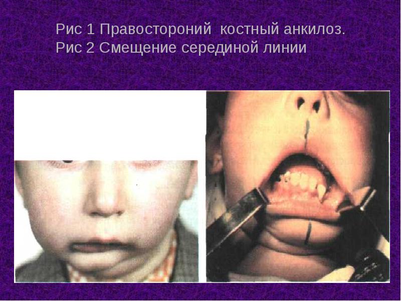 Рис 1 Правостороний костный анкилоз. Рис 2 Смещение серединой линии Рис 1 Правостороний костный анкилоз. Рис 2 Смещение серединой линии