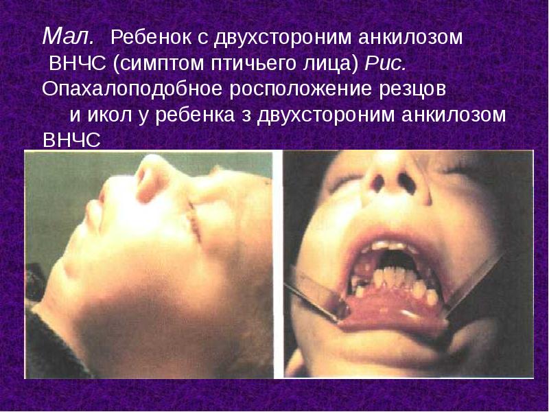 Мал. Ребенок c двухстороним анкилозом ВНЧС (симптом птичьего лица) Рис. Мал. Ребенок c двухстороним анкилозом ВНЧС (симптом птичьего лица) Рис.