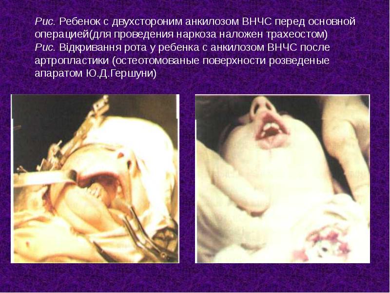 Рис. Ребенок с двухстороним анкилозом ВНЧС перед основной операцией(для проведения наркоза Рис. Ребенок с двухстороним анкилозом ВНЧС перед основной операцией(для проведения наркоза