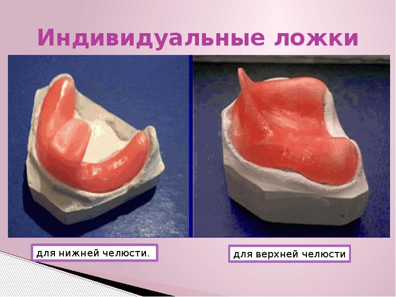 Припасовка индивидуальной ложки на верхней челюсти проводят по следующему плану