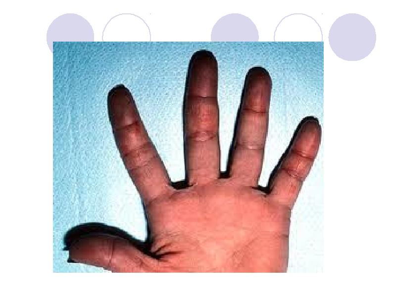 Презентация обморожения и ожоги