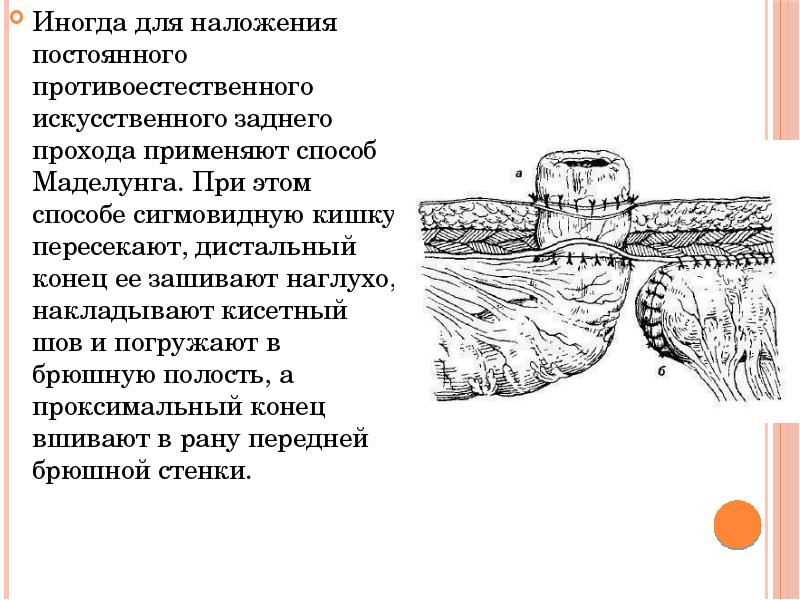 Противоестественный задний проход и колостома - презентация, доклад, проект