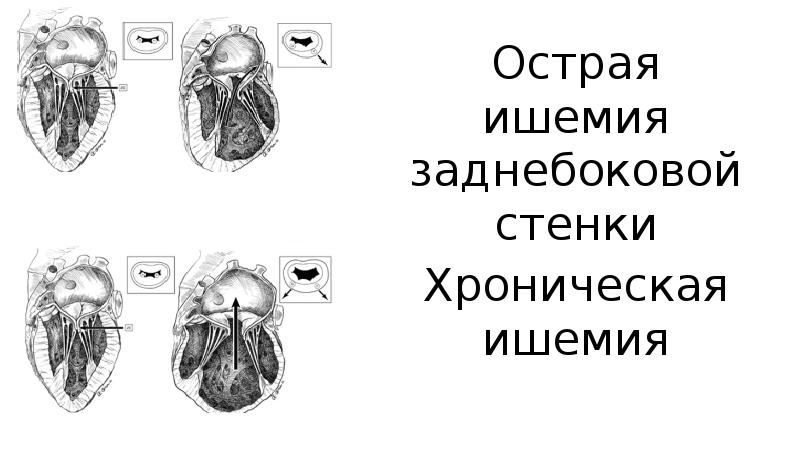 Код по мкб недостаточность митрального клапана. Порок митрального клапана мкб 10 мкб. пролапс митрального клапана код по мкб 10.