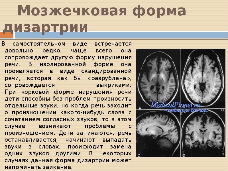 Мозжечковая форма дизартрии. Мозжечковая дизартрия. Симптоматика мозжечковой дизартрии. Мозжечковая дизартрия локализация поражения.