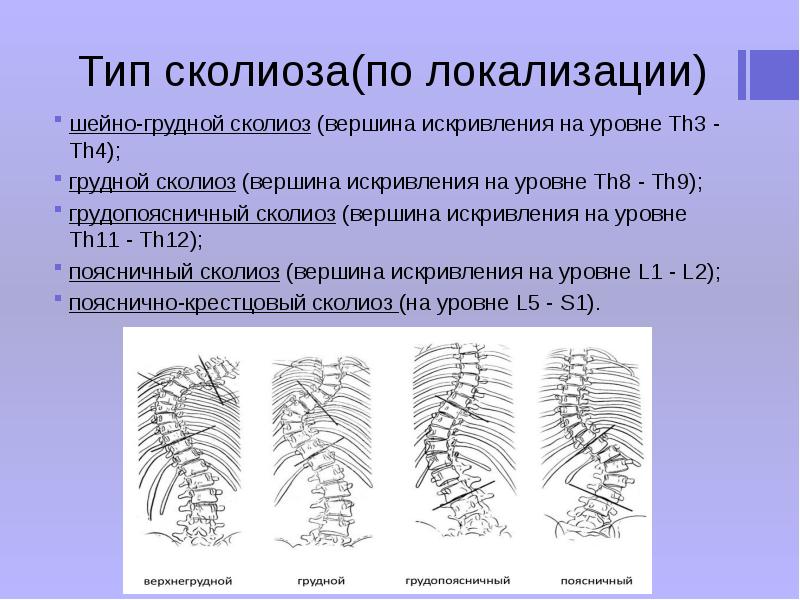 Грудной сколиоз. Верхнегрудной сколиоз. Типы сколиозов по локализации. Шейно-грудной сколиоз. Сколиоз по локализации искривления.