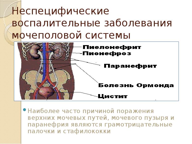 Воспаление мочеполовой системы. Сообщение на тему заболевания мочеполовой системы. Инфекции мочеполовой системы у женщин лечение. Верхние мочевыводящие пути. Выделения при воспалении мочеполовой системы у мужчин.