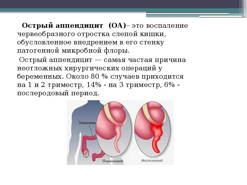 B клинической картине острого аппендицита c развитием деструкции червеобразного отростка