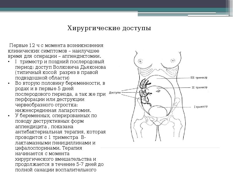 Острый аппендицит у беременных презентация