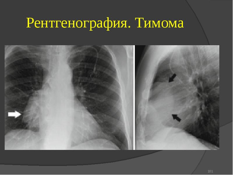Тимома рентгенологическая картина. Мелкоузловая тимома. Примеры диагноза тимома.