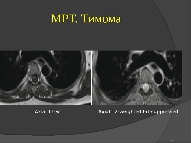 Тимома степени НП снимках. Примеры диагноза тимома.