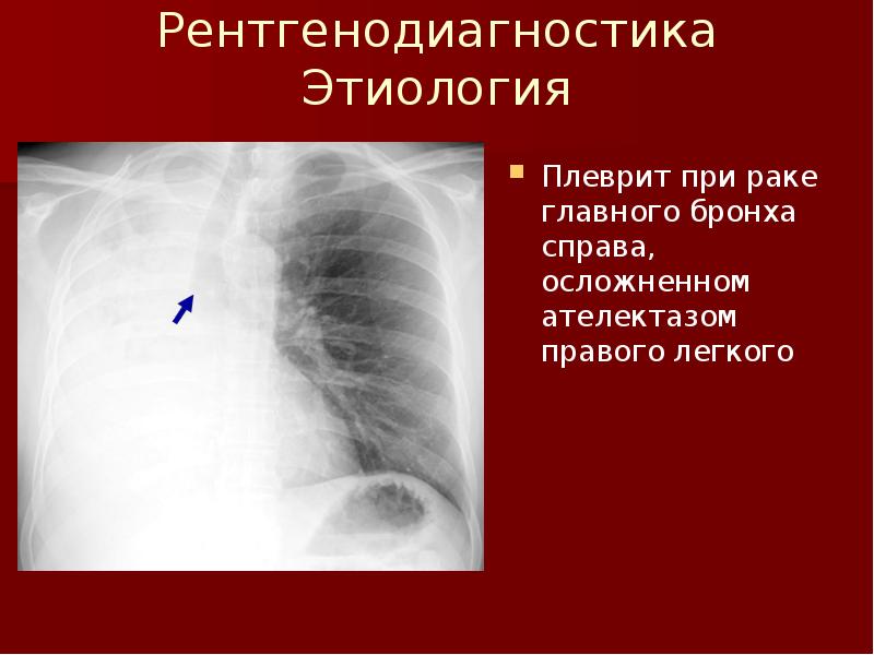 Ателектаз легкого презентация