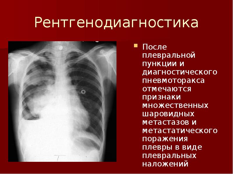 Объясните почему на рентгеновском снимке изображение газа в плевральной полости черное