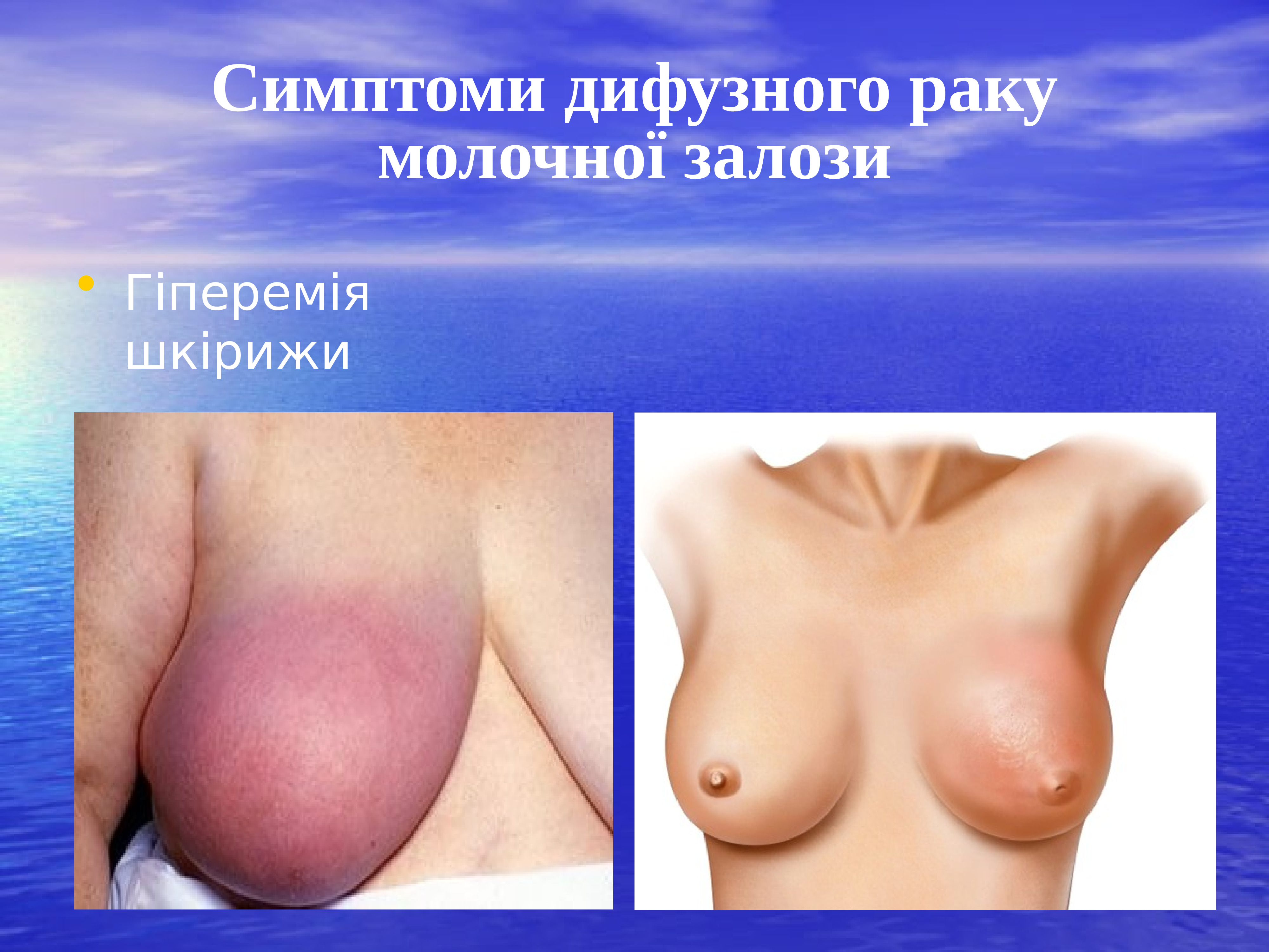 признаки онкологии груди у женщин фото 117