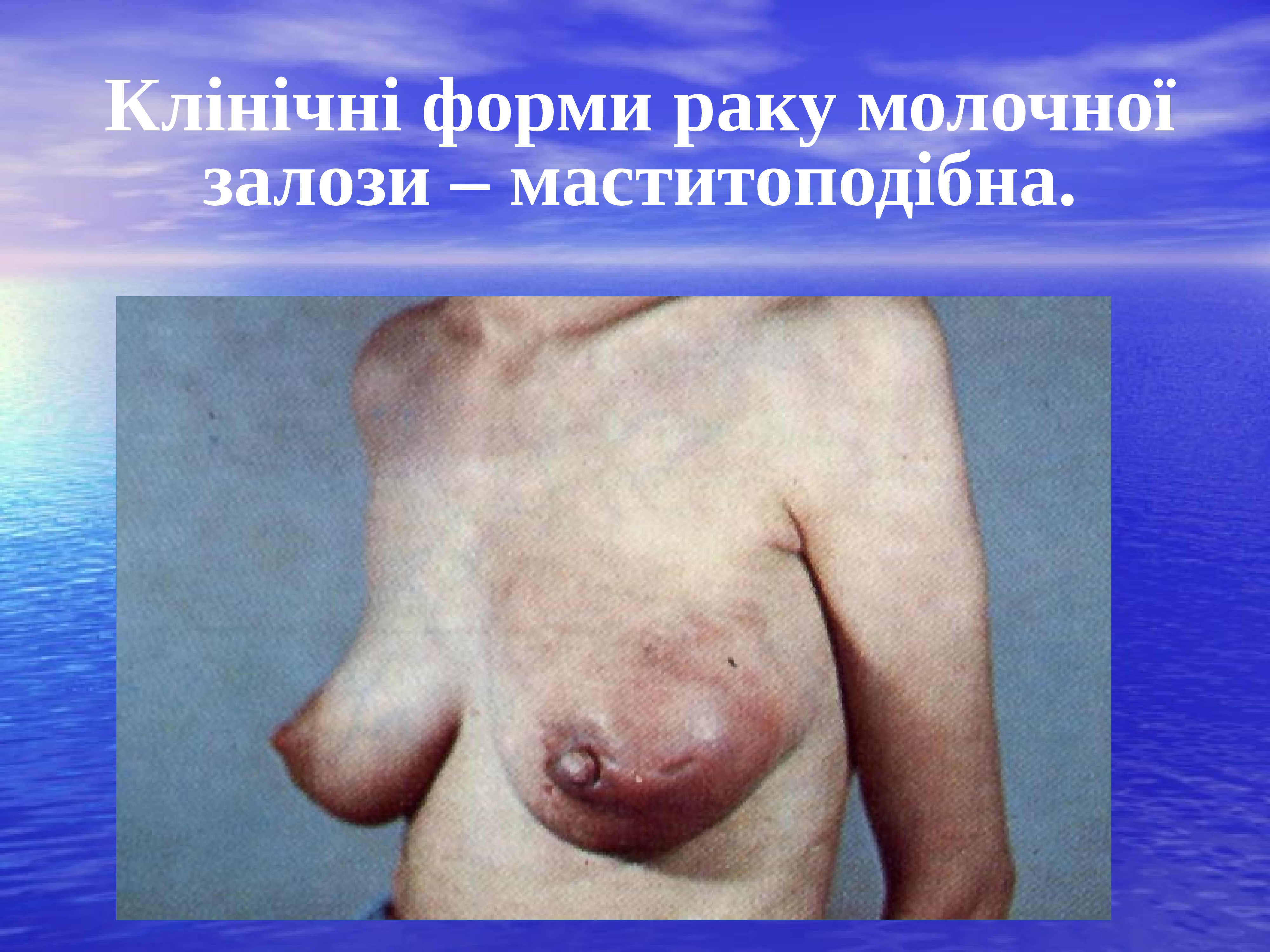 опухоль груди у мужчин признаки фото 93
