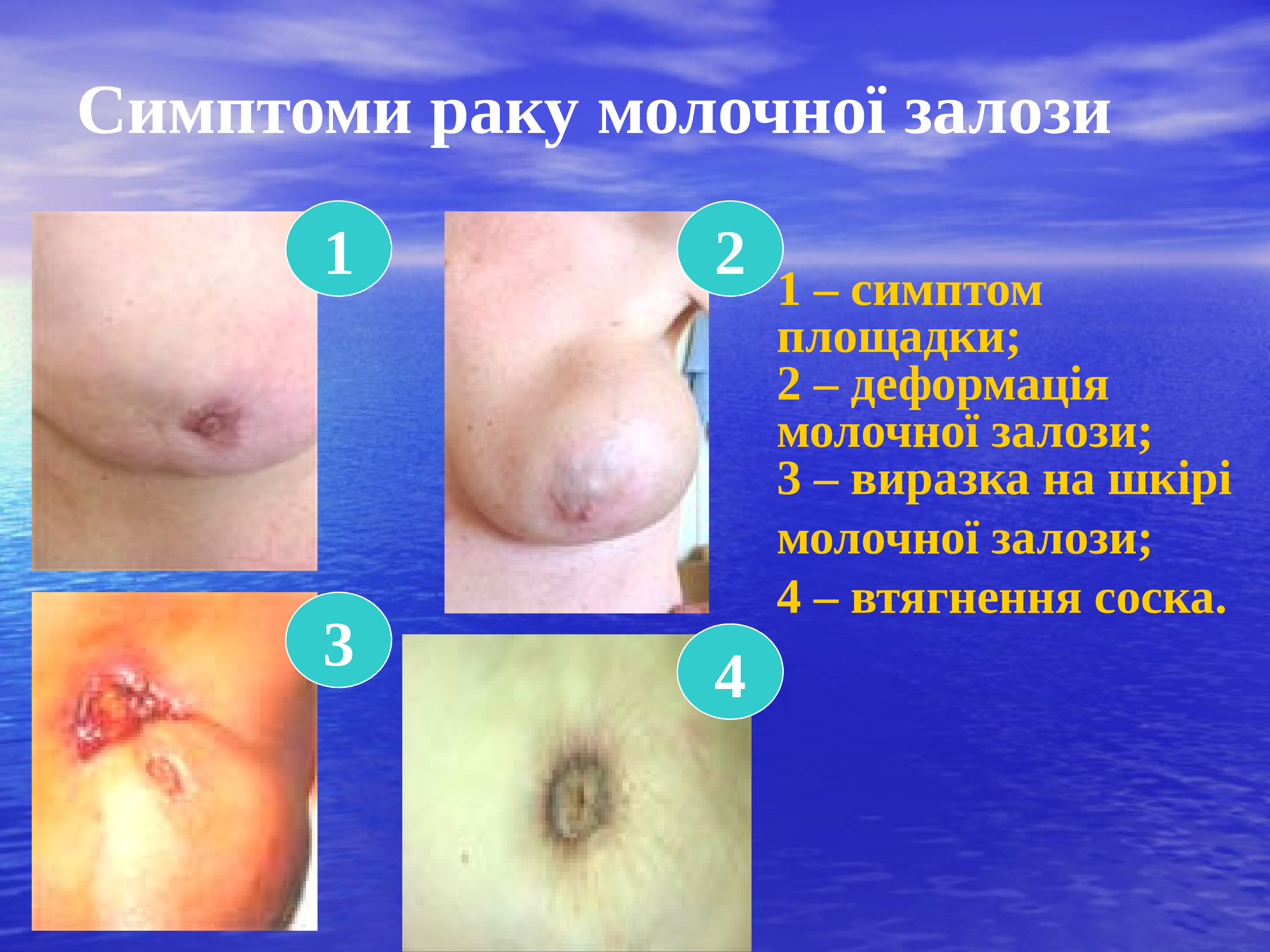 симптомы при раке груди у женщин фото 72