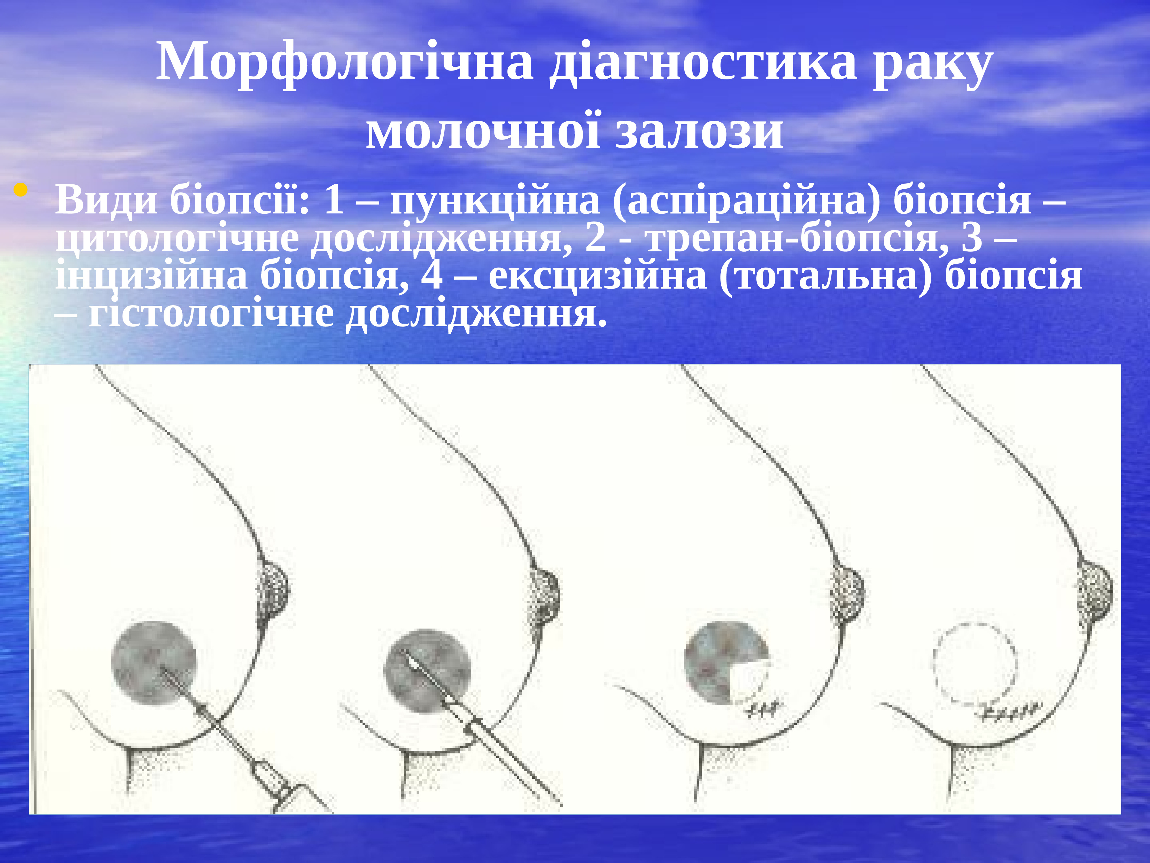 Молочная железа метод. Методы исследования молочной железы. Виды биопсии. Виды биопсии молочной железы в онкологии. Морфологическая диагностика опухолей.