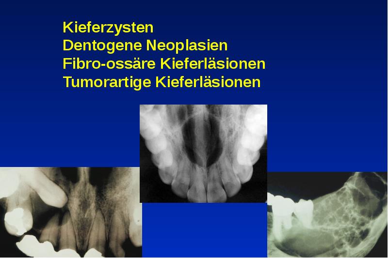 Kieferzysten Dentogene Neoplasien Fibro-ossäre Kieferläsionen Tumorartige Kieferläsionen Kieferzysten Dentogene Neoplasien Fibro-ossäre Kieferläsionen Tumorartige Kieferläsionen