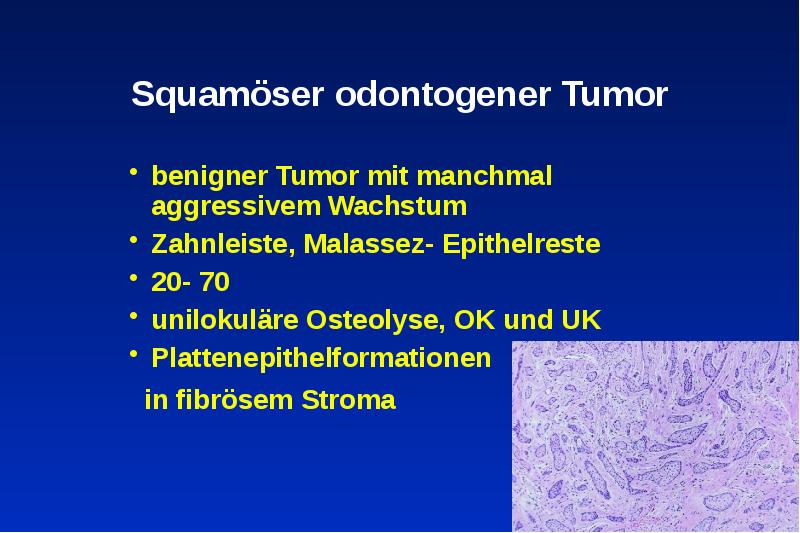 Squamöser odontogener Tumor
benigner Tumor mit manchmal aggressivem Wachstum
Zahnleiste, Malassez- Squamöser odontogener Tumor
benigner Tumor mit manchmal aggressivem Wachstum
Zahnleiste, Malassez-
