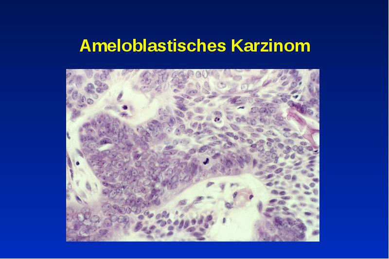 Ameloblastisches Karzinom Ameloblastisches Karzinom