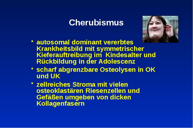 Cherubismus autosomal dominant vererbtes Krankheitsbild mit symmetrischer Kieferauftreibung im Kindesalter und