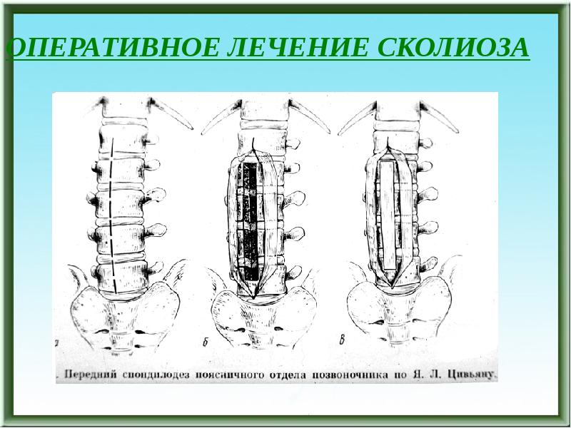 Хирургическое лечение сколиоза презентация